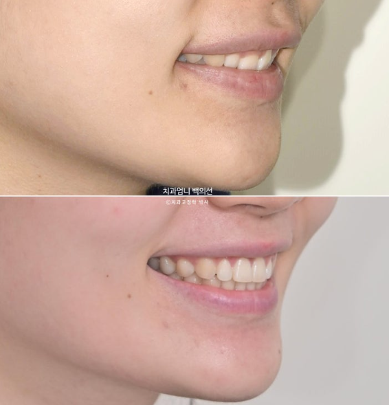 거미스마일 과개교합 교정 잇몸돌출 잇몸 비대칭 관련 이미지 1