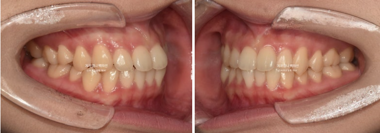 인비절라인 교정 비발치 비대칭 덧니 중심선 선천적 결손치 교정? 관련 이미지 4