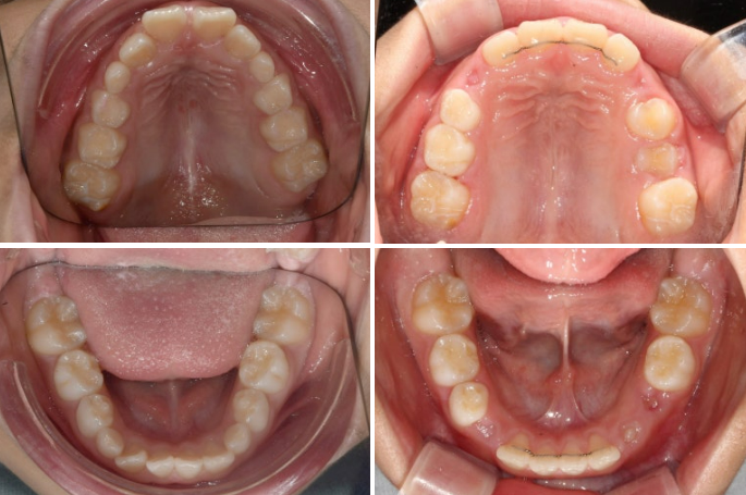 Invisalign First Correction for a Retruded Chin in a Child Orthodontic Treatment for Protrusion image 22