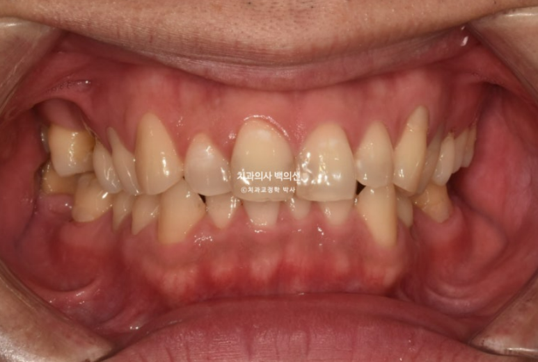 40대 인비절라인 라이트 과개교합 과잉치 덧니 교정 임플란트 보철 교정 후기 관련 이미지 3