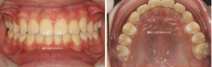 덧니 인비절라인 교정 :: 강남 인비절라인 교정치과 관련 이미지 5