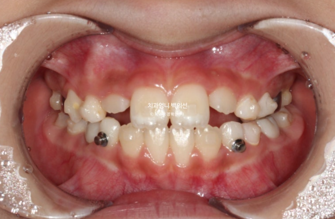 어린이 교정 인비절라인 퍼스트 비대칭 반대교합 어린이 성장 교정 관련 이미지 9