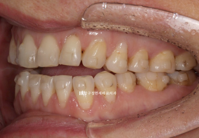 50대 인비절라인 개방교합 합입교정 미니스크류 관련 이미지 11