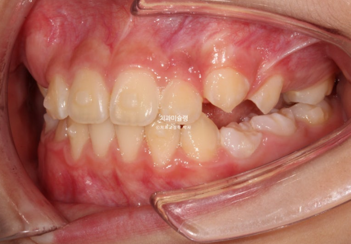 어린이 돌출입 교정 무턱 투명교정 인비절라인 퍼스트 관련 이미지 10