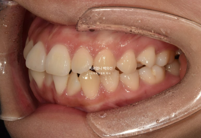앞니 부분 교정 급속 교정 토끼이빨 MTA 미니튜브 치간삭제 치료기간 9개월 관련 이미지 4
