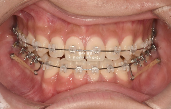 비수술 비발치 주걱턱 절충치료 클리피씨 개방교합 반대교합 치료 관련 이미지 6