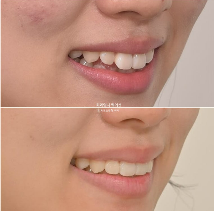 앞니 부분 교정 토끼이빨 덧니교정 ? 관련 이미지 18
