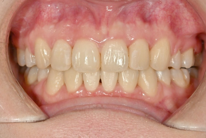 돌출입 인비절라인 발치교정 거미스마일 잇몸미소 잇몸돌출 입술부전증 무턱 재교정 관련 이미지 14