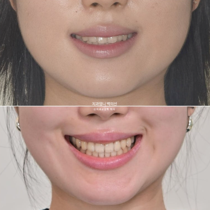 인비절라인 교정 비발치 비대칭 덧니 중심선 선천적 결손치 교정? 관련 이미지 19