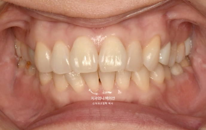 50대 치아교정 교합평면 기울어짐 토끼이 덧니 교정? 관련 이미지 1