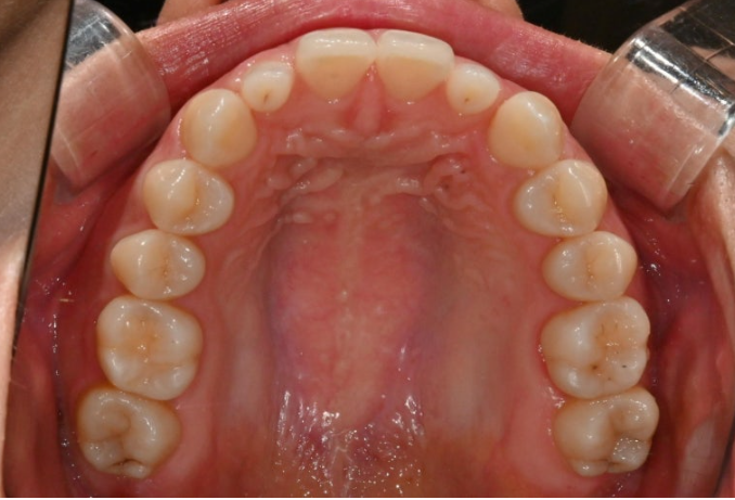 왜소치 반점치 (반상치)가 있는 경우 무삭제 라미네이트 치료 관련 이미지 3