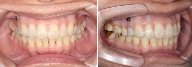 50대 캔팅 교합평면 기울어짐 덧니 교정 인비절라인 라이트 교정? 관련 이미지 5