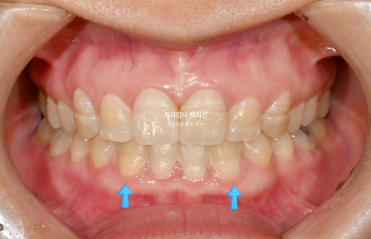30대 교정 돌출입 교정 덧니 발치교정 치료기간 1년 8개월 관련 이미지 9