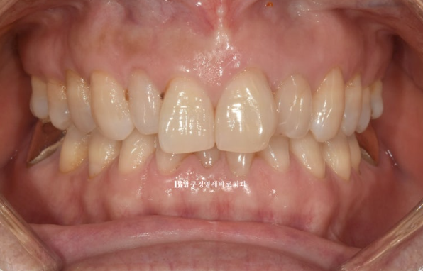 50s Invisalign Lite No-Prep Laminate Bunny Teeth image 2