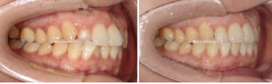토끼이빨 치아교정 ? 토끼이빨 교정 치료기간은 어떻게 되나요? 관련 이미지 8