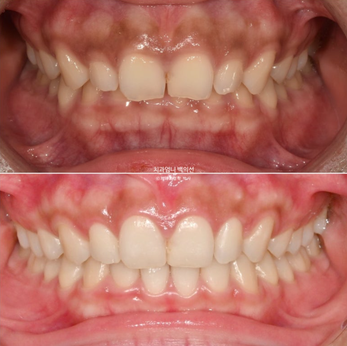 과개교합 옥니 거미스마일 교정 인비절라인 라이트 잇몸성형 후기 관련 이미지 1