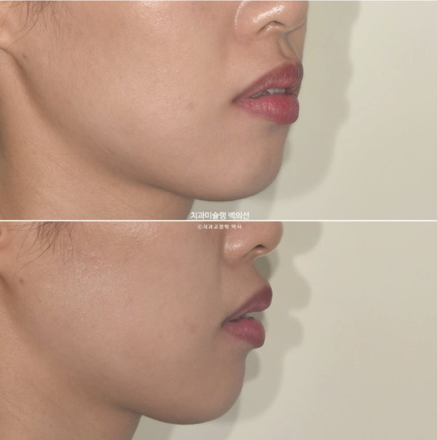 인비절라인 돌출입 발치교정 임플란트 없이 사랑니 대체 관련 이미지 7