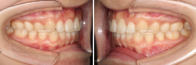 거미스마일 과개교합 교정 잇몸돌출 잇몸 비대칭 관련 이미지 11