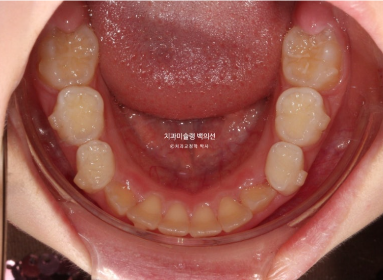 어린이 무턱 성장교정 덧니 인비절라인 퍼스트 악궁확장 치료기간 2년 관련 이미지 13