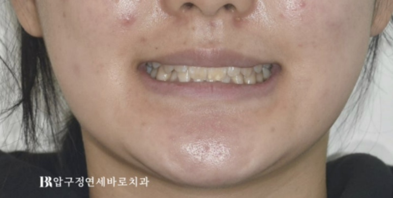 옥니교정 / 웃을때 아랫니만 보여요. 앞니 노출도 교정? 관련 이미지 4