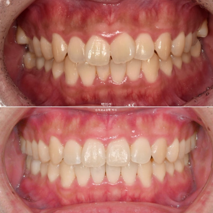 가위교합 나비치아 미니스크류 덧니 교정 인비절라인 라이트 관련 이미지 20