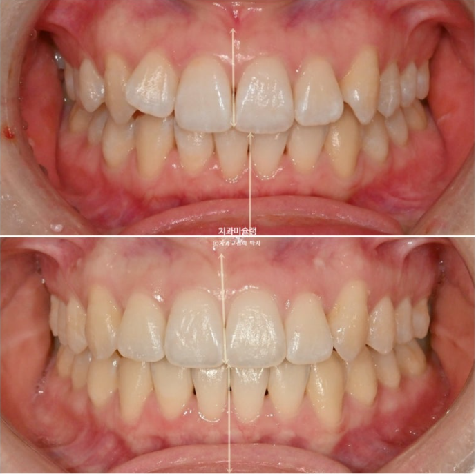 덧니 인비절라인 라이트 잇몸미소 거미스마일 중심선 블랙트라이앵글 관련 이미지 17