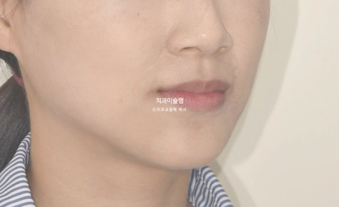 인비절라인 비발치 제2대구치 발치 사랑니 대체 교정 심한 덧니 교정 치료 관련 이미지 7