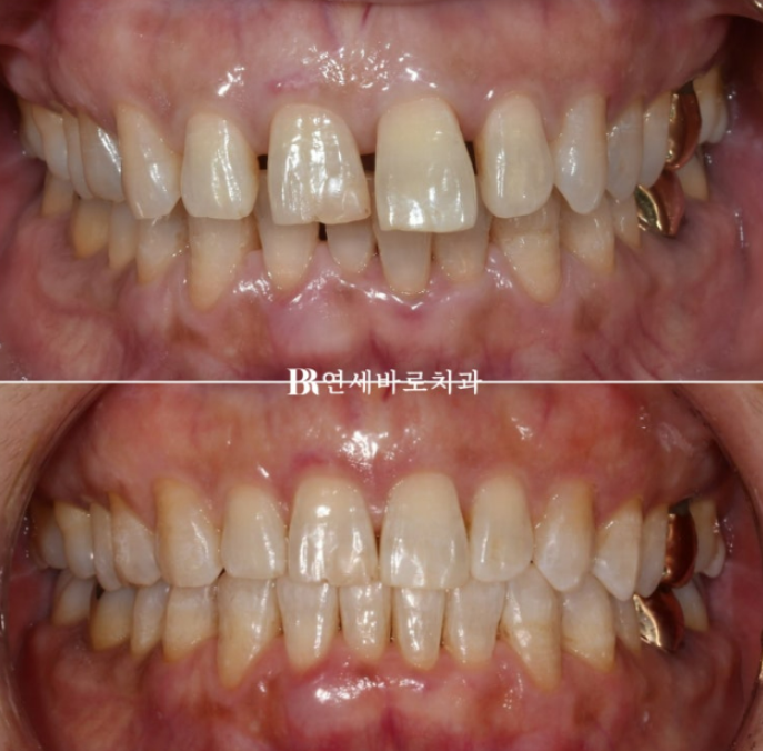 50대 60대 중년 치아 벌어짐 단기 교정 해결하기 관련 이미지 5