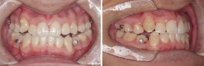 투명교정 인비절라인 덧니 교정 치료기간 알아보기 관련 이미지 5