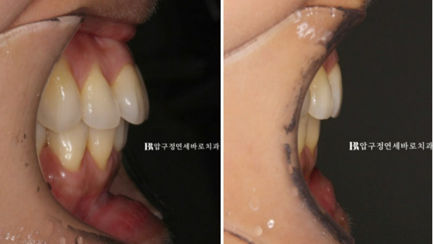 블랙트라이앵글 없애는 교정 가능할까요? 재교정 단기교정 후기 관련 이미지 9