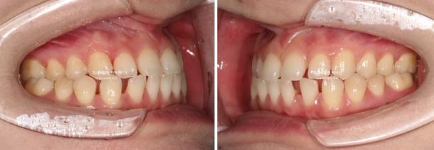 앞니 벌어짐 합죽이 방지 교정 기간 1년 4개월 관련 이미지 4