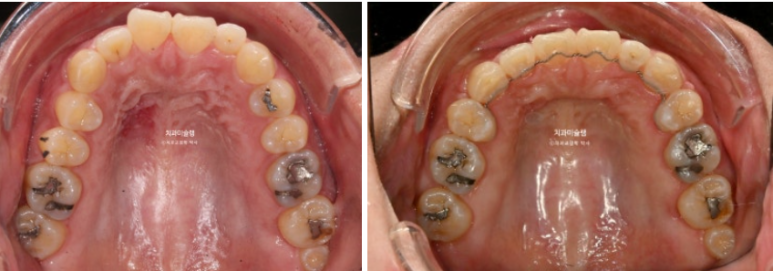 Extraction Orthodontics with Clippy-C for Protruding Mouth, Gum Smile, Gummy Smile Correction, and Treatment for a Recessed Chin image 12