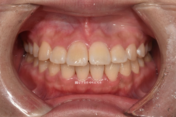인비절라인라이트 재교정 뻐드렁니 교정 돌출 교정 관련 이미지 1