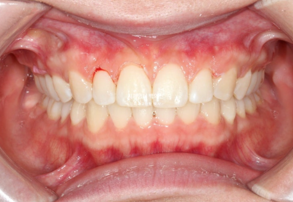 거미스마일 과개교합 교정 잇몸돌출 잇몸 비대칭 관련 이미지 10