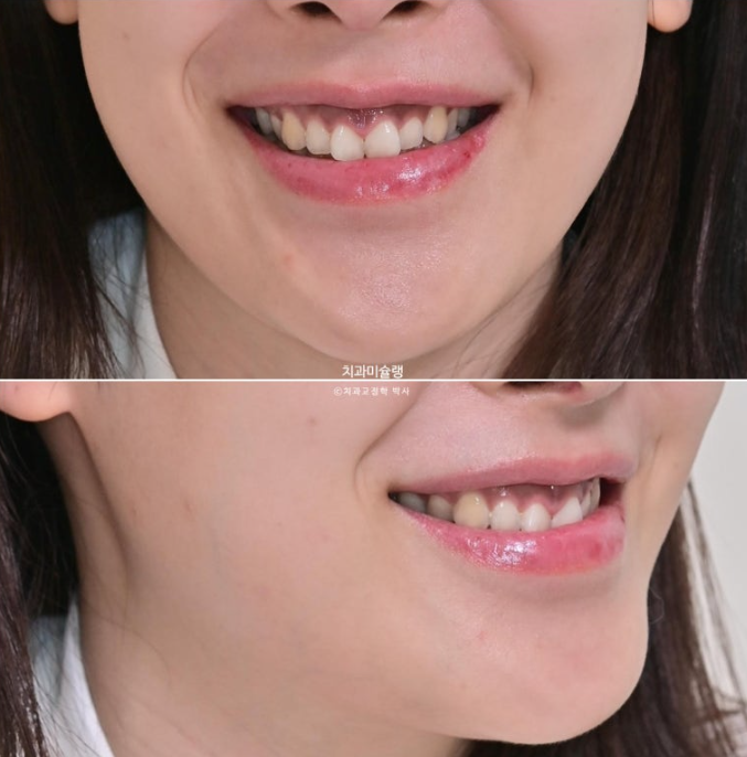 선수술 양악수술 비대칭 주걱턱 잇몸미소 치료 인비절라인 라이트 관련 이미지 2