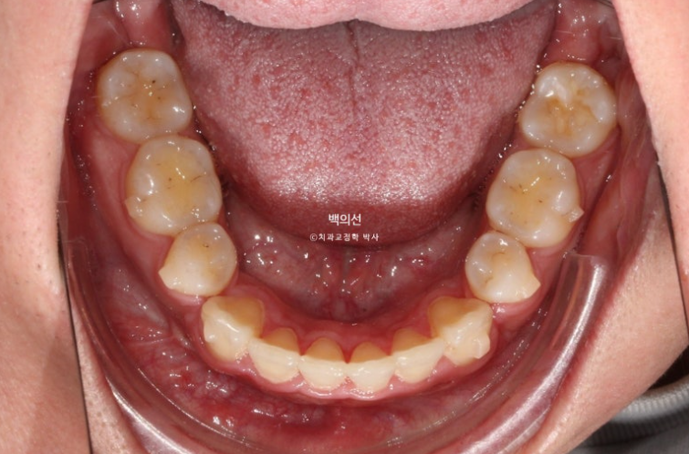 돌출입 수술 ASO + 인비절라인 라이트 후교정 치료기간 10개월 관련 이미지 11