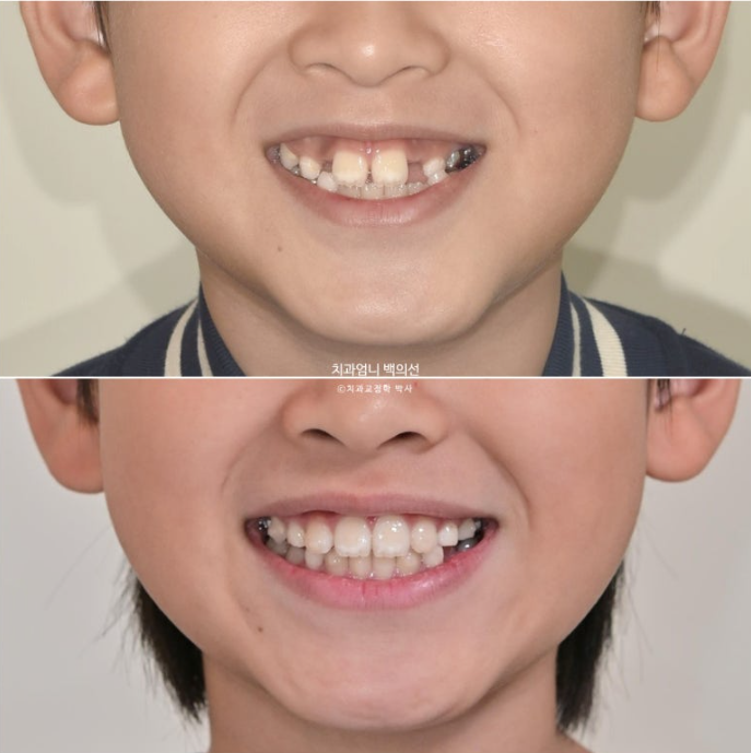 어린이 교정 인비절라인 퍼스트 비대칭 반대교합 어린이 성장 교정 관련 이미지 19