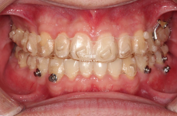 비대칭 비발치 거미스마일 잇몸미소 중심선 가위교합치료 무삭제 라미네이트 관련 이미지 18