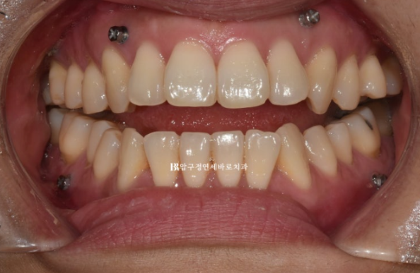 Is Invisalign Treatment Possible After Double-Jaw Surgery? A Real One-Year Case of Surgery-First Orthodontic Treatment image 3