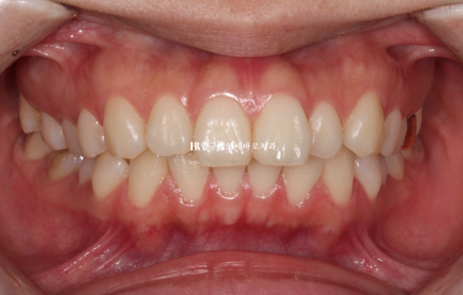 Gummy Smile Correction, Gummy Smile Orthodontics, Rabbit Teeth Correction image 2