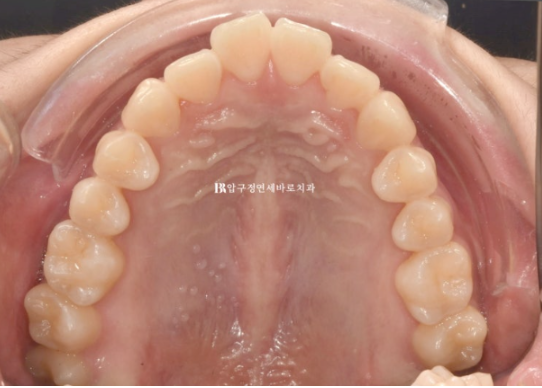 인비절라인 익스프레스 토끼이빨 교정 기간? 인비절라인 종류는? 관련 이미지 3