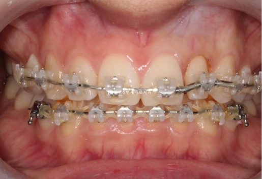 앞니 부분교정은 어떤 경우에 가능한가요? 단기 앞니 부분교정 왜소치 치료 무삭제 라미네이트 관련 이미지 6