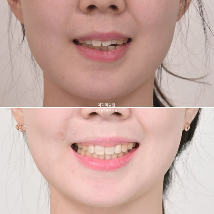 비발치 인비절라인 교정 편측 개방교합 가위교합 돌출 재교정 관련 이미지 23