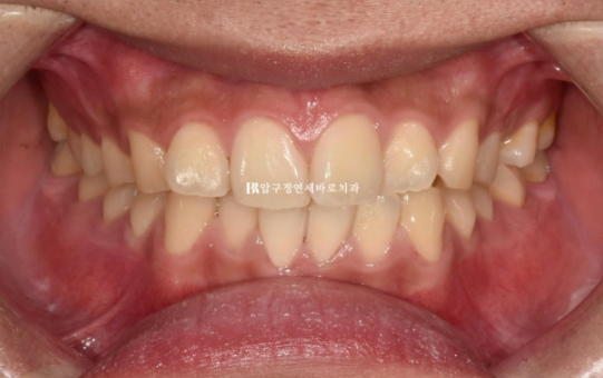 인비절라인 라이트 교정 덧니 이소맹출 반대교합 관련 이미지 2