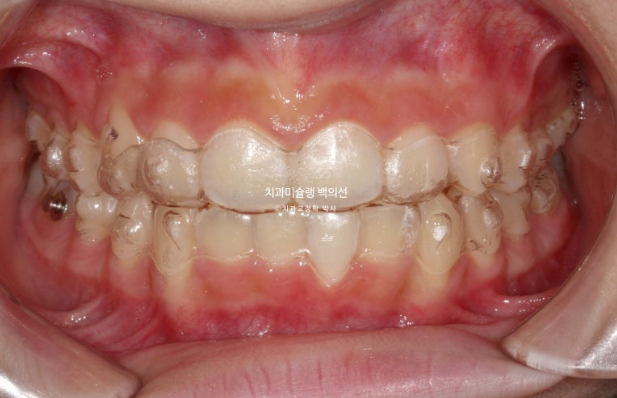 과개교합 인비절라인 모더레이트 컴프레헨시브 중심선 토끼이빨 관련 이미지 6