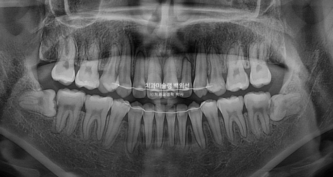 비수술 주걱턱 비대칭 발치 교정 결손치 반대교합 클리피씨 치료기간 1년 11개월 관련 이미지 20