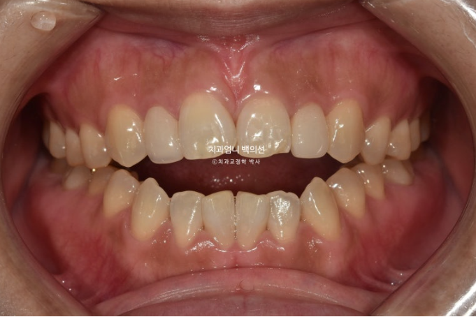 비수술 개방교합 클리피씨 30대 무삭제 라미네이트 치료기간 2년 관련 이미지 2