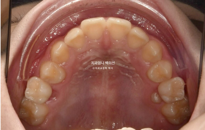 어린이 투명교정 인비절라인 퍼스트 가위교합 돌출교정 덧니교정 관련 이미지 4