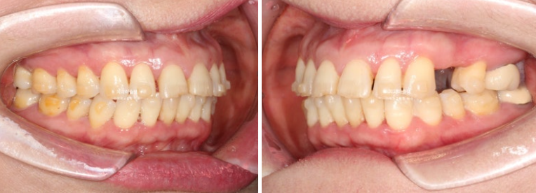 50대 치아교정 돌출 치아벌어짐 중년교정 관련 이미지 9