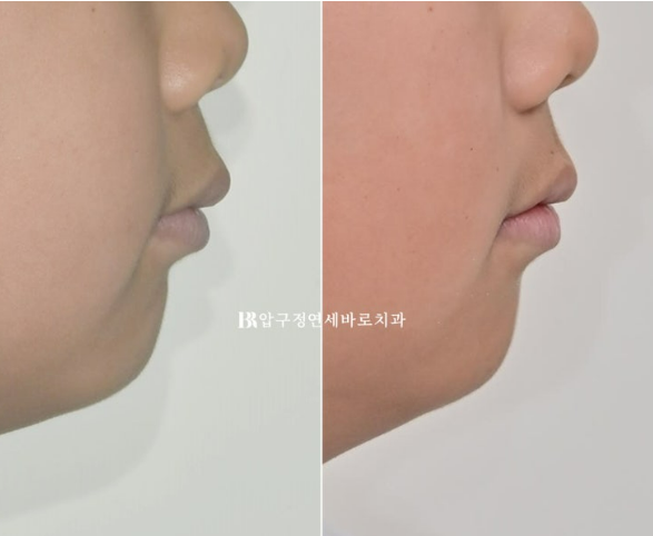 어린이 무턱 성장교정, 인비절라인 퍼스트 MA로 치료한 골격성 II급 부정교합 증례 관련 이미지 23